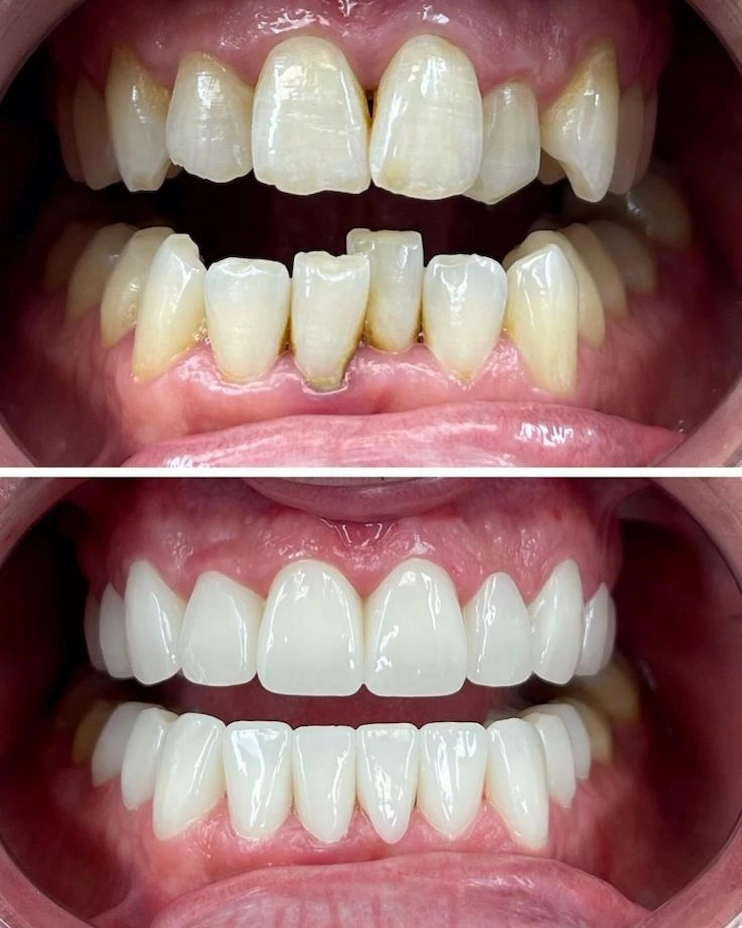 Before and after teeth whitening transformation at Joysmile Dental Clinic Juja